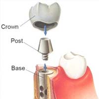 Dental Implant by The Beverly Dentistry