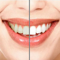 tooth-whitening-200