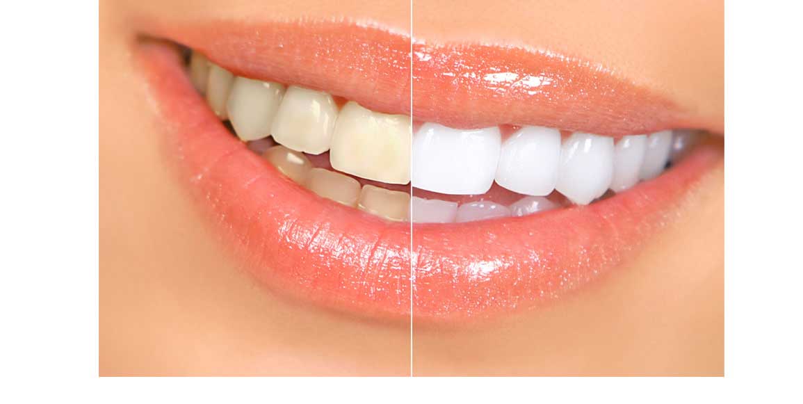 tooth-whitening-by-the-beverly-dentistry
